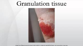 Granulation tissue [upl. by Casi612]