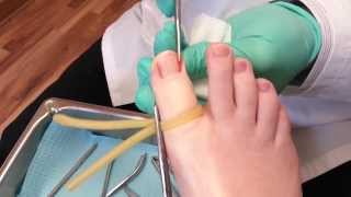 Ingrown toenail surgery [upl. by Medea147]