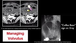 Volvulus sigmoid vs cecal vs gastric [upl. by Cecilla715]