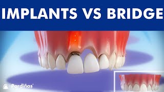 Dental Implants VS Tooth bridge  Comparison © [upl. by Leggett87]