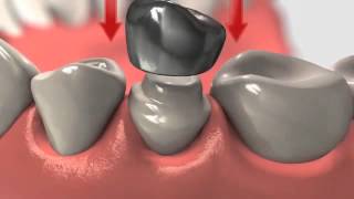 Dental Crown  Crowns And Root Canal Treatment [upl. by Savinirs]