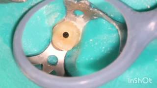 Root canal treatment full step by step [upl. by Sanez]