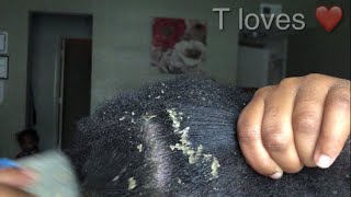 Satisfying scalp scratching flake lifting video 😊 [upl. by Asinla687]