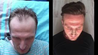 HAIR TRANSPLANT With 4360 Grafts Manual FUE  Two Surgeries Sessions at a Difference of 8 Years [upl. by Linis945]