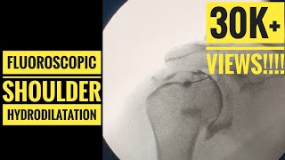 Hip Injection under Xray Fluoroscopy tutorial Contains graphic detail [upl. by Dietsche]