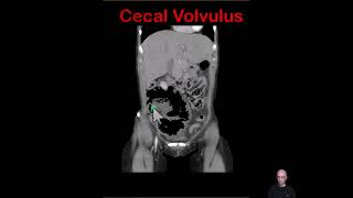 Cecal Volvulus [upl. by Ifok]