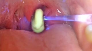 Worlds Greatest Tonsil Stone Removals 2 [upl. by Eilyah]