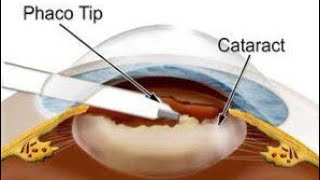 Phacoemulsification for Cataract  All you want to know about cataract surgery [upl. by Nasar]