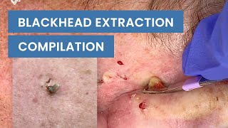 Extraction Satisfaction Blackhead Removal  CONTOUR DERMATOLOGY [upl. by Doehne]