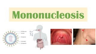 Infectious Mononucleosis Mono  EpsteinBarr Virus Transmission Symptoms Diagnosis Treatment [upl. by Adnilak24]