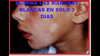 ELIMINA LAS MANCHAS BLANCAS EN SÓLO 3 DÍAS  FÁCIL Y RÁPIDO [upl. by Aleydis]