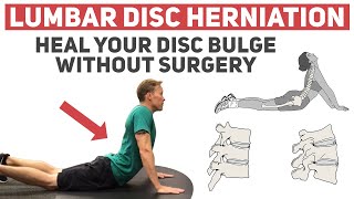 How to Treat a Lumbar Disc Tear or Disc Herniation by Dr Mike Hsu [upl. by Eirok279]