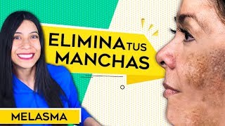 Como Eliminar MANCHAS en la piel  Melasma Tratamiento  MANCHAS CAFES [upl. by Nie]