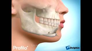 Chin Augmentation Surgery Genioplasty [upl. by Ecylla]