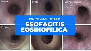 Esofagitis Eosinófilica Cómo diagnósticarlo y tratarlo en el 2021 [upl. by Lugo856]