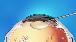 Phacoemulsification Cataract Surgery [upl. by Aerised]