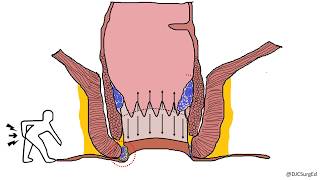 Hemorrhoids [upl. by Atla]