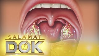 Salamat Dok Information about tonsil stones [upl. by Attesoj]