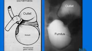 Gastric Volvulus in a Newborn [upl. by Asseret]