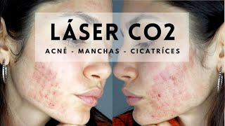 ACNÉ LASER CO2 Manchas y Cicatrices  Niki Mayo [upl. by Fablan]