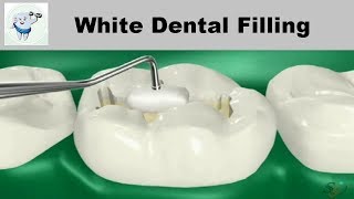 Composite Dental Filling Procedure [upl. by Danita]