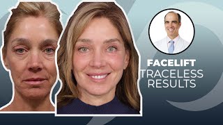 10 YEARS YOUNGER Traceless Facelift Surgery Before and After  Dr David Stoker [upl. by Ydnarb]