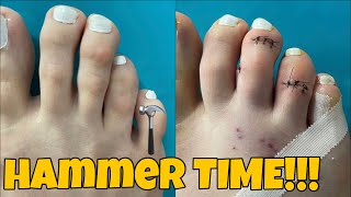 MINIMALLY INVASIVE HAMMERTOE SURGERY [upl. by Dollar]