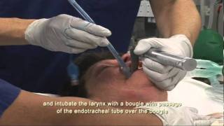 extubation correct technique [upl. by Eilahs]