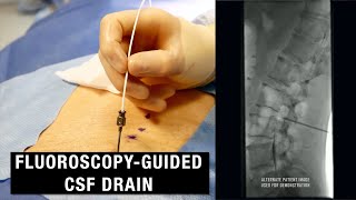 Knee Injection under Fluoroscopy  ThePainSourcecom [upl. by Inah]