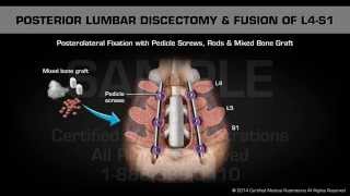 Posterior Lumbar Discectomy amp Fusion of L4S1 [upl. by Assile483]