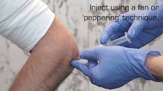 Injection Technique for Lateral Epicondylalgia [upl. by Ecirp]