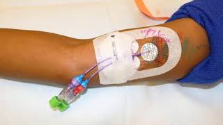 USG Guided Dialysis Catheter Insertion  Dr Sandeep Gopinath Huilgol  Nephrology PrepClinic [upl. by Colley]