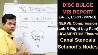 Herniated disc MRI How to read MRI lumbar spine Nerve compression L4L5 L5S1 Canal Stenosis [upl. by Arammahs]