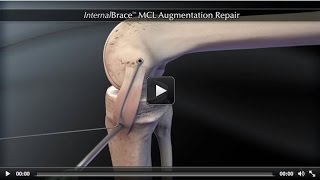 InternalBrace™ MCL Augmentation Repair [upl. by Nanci]