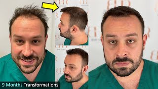 FUE Hair Transplant Surgery Update  Before And After Scalp And Body Hair BHR Clinic DrBisanga [upl. by Akinorev]