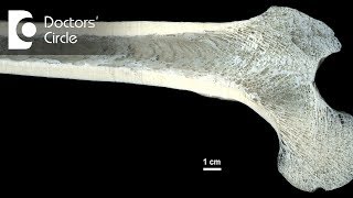 Pediatric Osteomyelitis  CRASH Medical Review Series [upl. by Isacco]