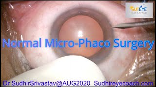 Normal MICSMicroPhacoemulsification Cataract Surgery DR SUDHIR SRIVASTAVA [upl. by Hcurob]