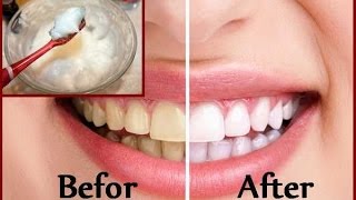 DIY Teeth Whitening at Home in 2 minutes [upl. by Inimod]