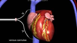 Cardiopulmonary Bypass in 2 minutes Animation by Cal Shipley MD [upl. by Tull874]