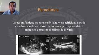 Colecistitis aguda Clínica diagnóstico exámenes complementarios y tratamiento [upl. by Rusel]