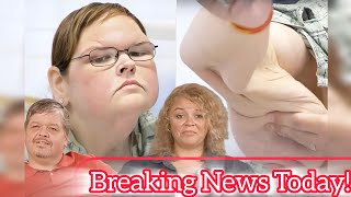 1000Lb Sisters Why Was Tammy Slaton’s Skin Removal Denied tammy 1000lbsisters tlc chriscombs [upl. by Messere]