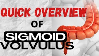 QUICK OVERVIEW of Sigmoid Volvulus [upl. by Yaron366]