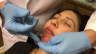 NonSurgical Chin Augmentation using Juvederm Voluma 3cc [upl. by Molli]