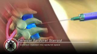 Cervical Epidural Steroid Injection Procedure Animation [upl. by Oileve]