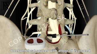 Lumbar Fusion of L5 S1 Posterior [upl. by Animas531]