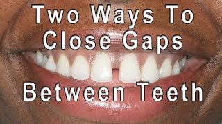 How to Close Gaps Between Teeth [upl. by Llirred510]