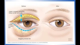 LASIK Surgery Performed In RealTime At LASIK MD [upl. by Sanford]