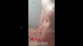 Jugular Venous Pulse Identification [upl. by Shaughnessy]