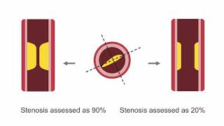 Assessing Lesion Severity in Coronary Angiography [upl. by Friedberg]