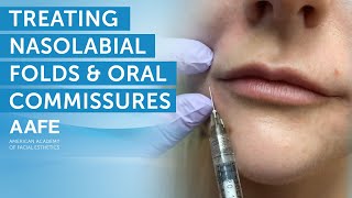 Fine Line Dermal Filler  treatment video [upl. by Codee247]